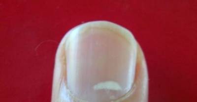 The White Dots On Your Nails Indicate A Lot, Here's An Answer!