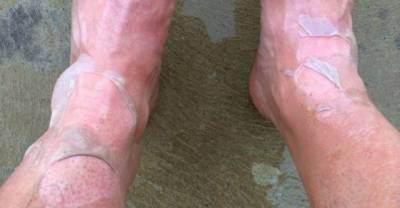 This Man's Leg Caught Fire Because Of Insect Repellent