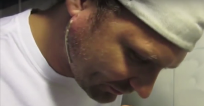 You'll Be Shocked When You See How Much Comes Out Of This Abscessed Pimple...