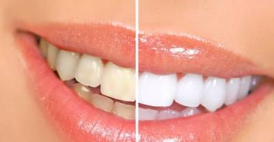Perfect 3-Minute Natural Remedy For Whiter Teeth, It Really Works!