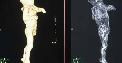 CT Scan Of Pompeii Mummies Reveal Shocking Details!