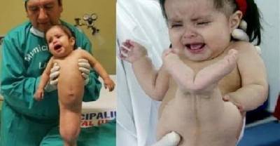 The Inspirational Story Of The "Little Mermaid" Girl