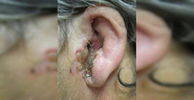 Apparently, Fungus Can Grow In Your Ear Canal...And It's Not Fun