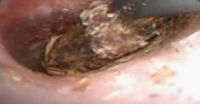 She Fell Asleep, And A Centipede Crawled Into Her Ear...The Removal Makes Me Sick