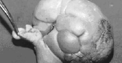 They Thought It Was A Tumor, But It Turned Out To Be His Own Twin