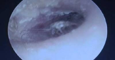 A Family Of Cockroaches Was Living Inside This Guy's Ears Until It Started Hurting
