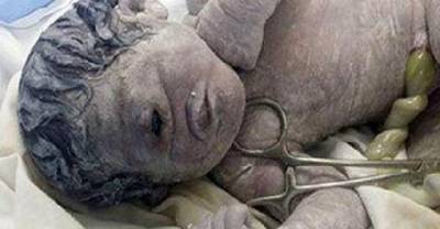 'Cyclops' Baby Born With One Eye After Radiation Exposure.. Heartbreaking!