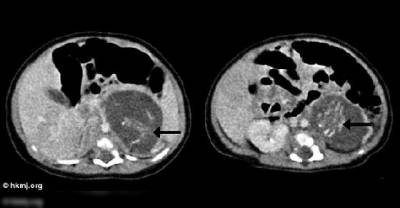 Chinese Baby Born 'Pregnant' With Twins. Shocking!