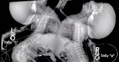 Doctor Panics When He Sees Mom's Twins Like This During Ultrasound. Now Watch What She Does...