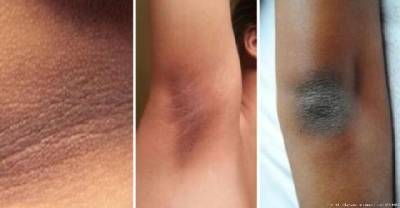 Finally An Easy Way To Get Rid Of Dry And Discolored Skin!