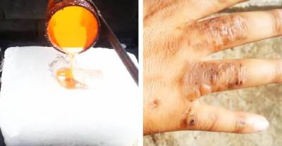 Brilliant Backyard Scientist Burns Hand After Pouring Molten Copper On Ice