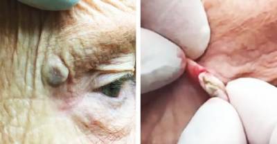 Doctor Pops Massive Blackhead That Had Been Growing For Years
