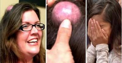 Woman's 20-Year-Old Cyst Finally Gets Popped