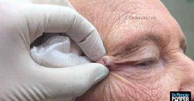 Doctor Finds Mother Of All Zits Sitting Near Elderly Woman's Eye For Years