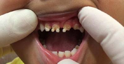 These Horrific Pictures Will Make You Give Up Sugar Forever!