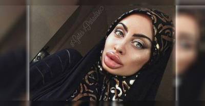 This Woman Might Have The Largest Lips On All Of Instagram
