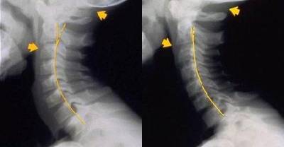 These Shocking 'Text Neck' X-rays Show How Children As Young As SEVEN Are Becoming Hunch Backs Because Of Their Addiction To Smart Phones