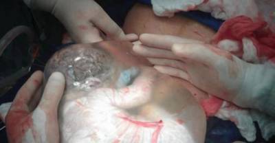 Baby Delivered Inside Amniotic Sac Stuns Doctors