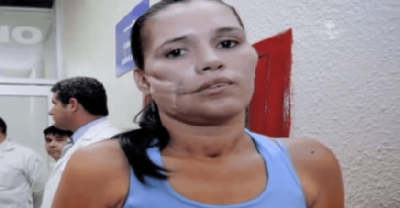 When You See What Doctors Extracted From Her Face You Will Freak Out