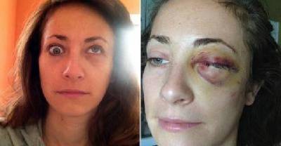 This Woman Is Cross-Eyed For Life After Injury On Halloween Party Bus