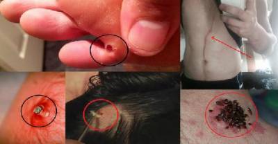 7 Shockingly Creepy Parasites Found Inside Human Body That Will Make Your Head Spin