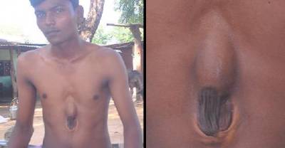 OMG! This Man Was Born With His Heart Beating Outside Of His Ribcage
