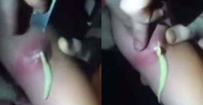 This Spooky Video Of A Girl Getting Her Blister Cut Open Is Weird And Bone-Shaking Read