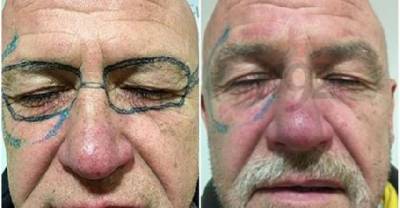 Guy Who Woke Up With Glasses Tattooed On His Face Finally Gets Them Removed