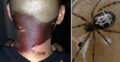 False Widow Spider Bite Had An Unbelievable Affect On This Guy&rsquo;s Neck