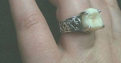 This Woman Got An Engagement Ring With Her Fiance&rsquo;s Wisdom Tooth