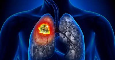 7 Signs And Symptoms That You May Have Lung Cancer