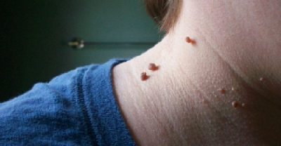 The Most Simple, Natural And Effective Way To Remove Skin Tags