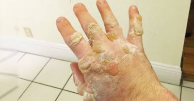 Man Puts His Hand Too Close To A Molten Lead Bubble