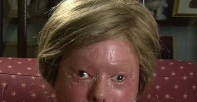 This Teen With Rare Skin Disease Can't Grow Hair Or Sweat