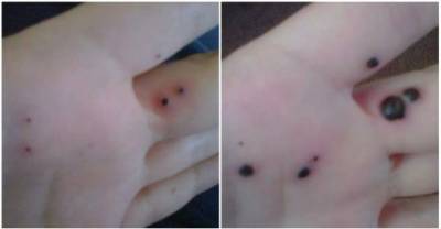 Husband Noticed Mysterious Black Spots On Wifes Hand