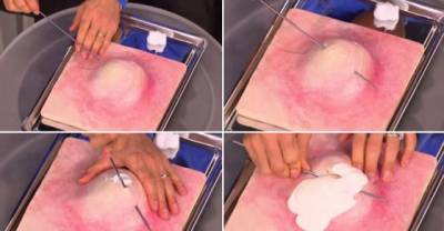 Can't Stop Picking Your Spots? Doctor Reveals The Best Way To Attack A Pimple Without Damaging Your Skin (But Be Warned, It's Not Pretty)