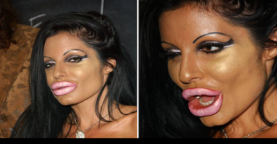 20 Plastic Surgeries That Went Horribly Wrong