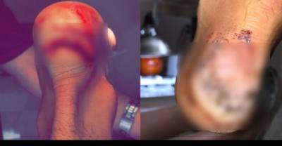 OMG! The Healing Process Of A Shark Bite Is Worse Than The Actual Bite