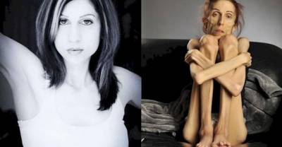 Anorexia Nearly Ended Her Life. Now She's Doing What Once Seemed Impossible!