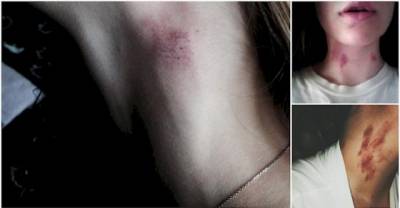 OMG! Dangerous Facts About Hickeys You NEED To Know