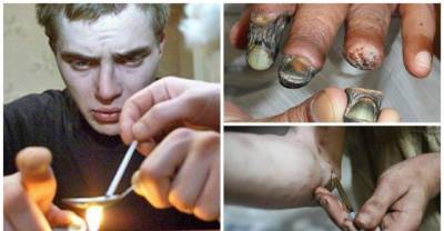 What Happens To Your Body When You Do Krokodil, The &ldquo;Zombie Drug&rdquo; (Warning Extremely NSFW)