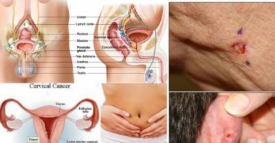 The 5 Most Common Types Of Cancer And Their Symptoms