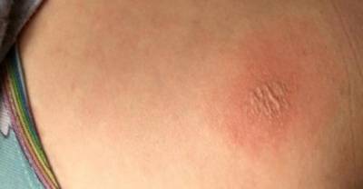 This iPhone Case Contains A Chemical Which Causes 2nd Degree Burns