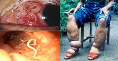 OMG! Scary Parasites Inside The Human Body That Would Make Your Head Hurt
