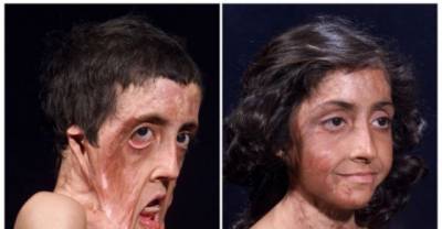 Their Deformed Faces Are Beautiful Again, All Thanks To Technology!