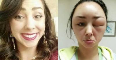 Girl Has A Bad Reaction To Hair Dye That Will Shock You