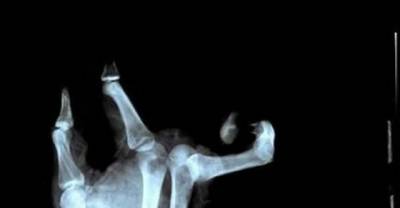 You&rsquo;ll NOPE For Days When You See Just How These People Broke Their Bones.. OMG!