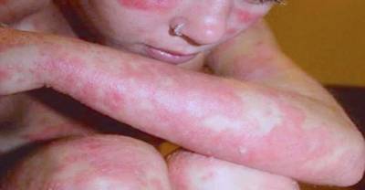 Red Patches On Her Skin Freaked Her Out. 11 Years Later, She's Doing This!
