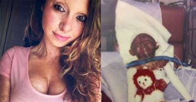 Inspirational Burn Victim Slams Bullies With Beautiful Tattoo