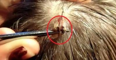 Ewww! Huge Botfly Maggot Removed From Man&rsquo;s Head